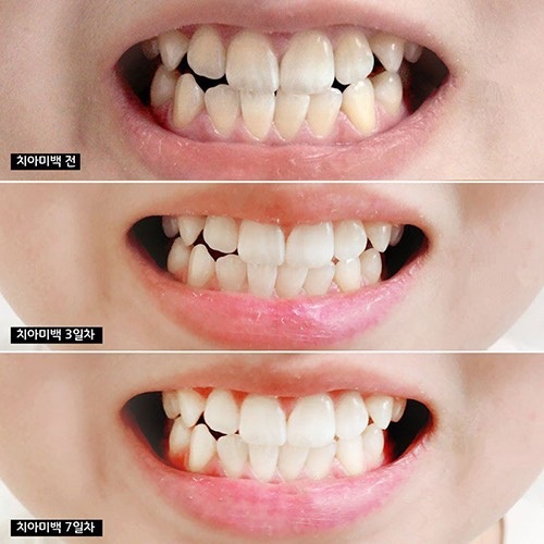 Kem danh rang Median Dental 93%